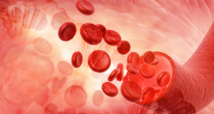 Анемија: Што да јадете, а што да избегнувате ако сте анемични