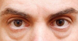 Како да се отстранат подочњаците? Постојат 3 начини