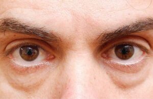 Како да се отстранат подочњаците? Постојат 3 начини