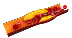 Ова се знаци кои може да укажуваат на тоа дека имате висок холестерол