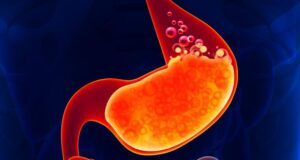 ГАСТРИТИС: 8 намирници кои ги ублажуваат симптомите!