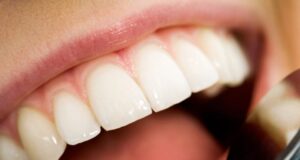 Забен камен: Направете ја оваа течност и намалете ја појавата