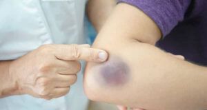 (РЕЦЕПТ)Модринките се сосема безопасни, но доколку сакате што побрзо да се ослободите од нив…