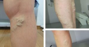 Превентивни мерки за проширени вени