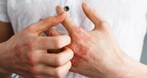 На кои начини може да се ублажат симптомите на егзема