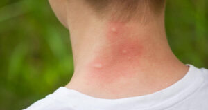 Зошто некои луѓе особено ги привлекуваат комарците? Еве што велат експертите