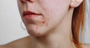 Не можете да се ослободите од акните? Ова може да биде скриената причина за тоа…