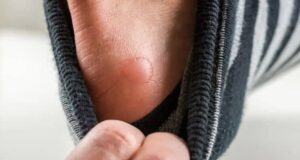 Дали страдате од плускавци? Трикови за заздравување многу побрзо и побезболно