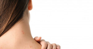 Еве што предизвикува појава на акни на грбот