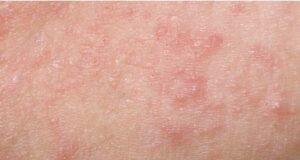 Храна што ја влошува егземата