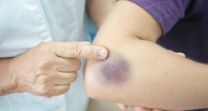 Обликот и бојата на модринката „кажуваат“ многу