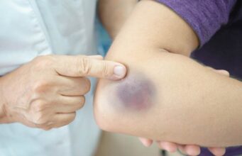 Обликот и бојата на модринката „кажуваат“ многу