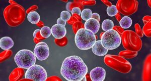 Леукемија: Симптоми кои не треба да се игнорираат