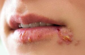 Заштитете се од херпес