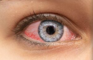 Црвени очи – Конјунктивитис