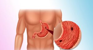 Спас за чир на желудникот