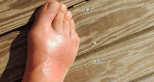 Мочна киселина во крвта