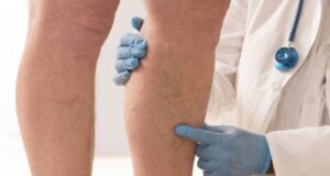 Телото испраќа знаци: Симптоми кои укажуваат на постоење на згрутчување на крвта