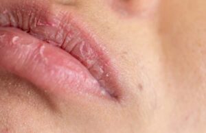Дали вашите усни се суви и отечени?