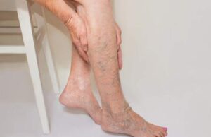 ОВИЕ ОБЛОГИ ДОНЕСУВААТ ГОЛЕМО ОСЛОБОДУВАЊЕ за време на топлото време: Варикозните и болните вени целосно исчезнуваат за 3 недели! (РЕЦЕПТ)