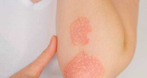 Што се автоимуни болести?