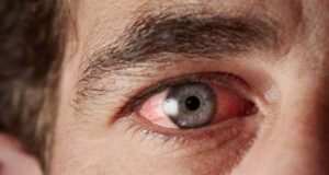 Ова се трите најчести типови на конјунктивитис и како се лекуваат!