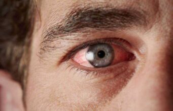 Ова се трите најчести типови на конјунктивитис и како се лекуваат!