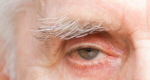 4 симптоми на деменција кои се појавуваат во очите, години пред меморијата да почне да бледнее