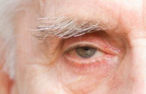 4 симптоми на деменција кои се појавуваат во очите, години пред меморијата да почне да бледнее