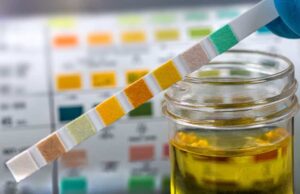 На што може да укаже високото ниво на шеќер во урината?