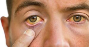 Хепатитис А, неговите причини и симптоми