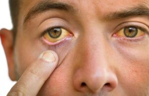 Хепатитис А, неговите причини и симптоми