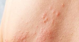 Херпес зостер: Ова се трите рани симптоми на инфекција со вирусот