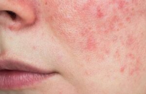 Пет знаци на лицето кои може да укажуваат на замастен црн дроб