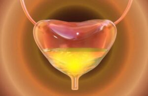 Што е хиперактивен мочен меур и кои симптоми укажуваат на оваа состојба