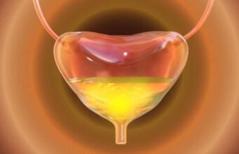 Што е хиперактивен мочен меур и кои симптоми укажуваат на оваа состојба