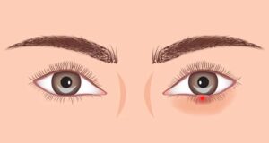 Чмичак или трн