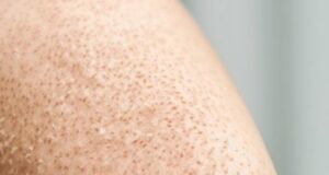 Еден знак на кожата може да предупреди дека ни недостасува витамин Ц