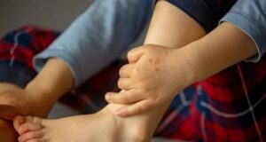 Што е вирусот Коксаки и како се лекува? Се пренесува со валкани раце, а ова се СИМПТОМИТЕ поради кои треба да одите на лекар