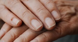 Природен третман за воспалени кутикули: Еве неколку домашни лекови кои помагаат при благи до умерени инфекции