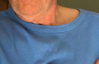 Која храна треба да се избегнува за време на срцебиење