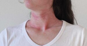 Афти во устата, постојани акни, рани на гениталиите се само дел од симптомите: Што е БЕХЧЕВАТА БОЛЕСТ и како се лекува?