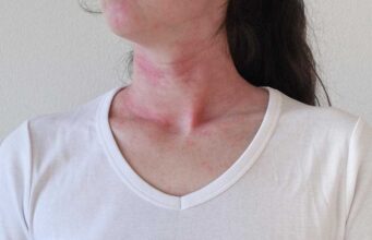 Афти во устата, постојани акни, рани на гениталиите се само дел од симптомите: Што е БЕХЧЕВАТА БОЛЕСТ и како се лекува?
