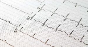 ШТО МОЖЕ ДА ОТКРИЕ АНАЛИЗАТА НА ЕКГ А ШТО НЕ?