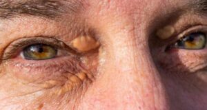 Симптоми на висок холестерол – можете да го видите на вашето лице! Сите го игнорираме знакот – Мислиме дека е нормално!