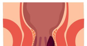 Дали имате проблем со хемороиди? Еве која храна е пожелна, а која најдобро да се избегнува