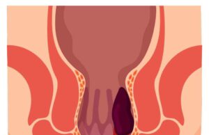 Дали имате проблем со хемороиди? Еве која храна е пожелна, а која најдобро да се избегнува