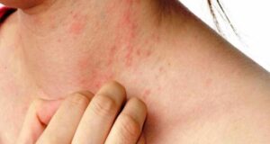 Дали имате алергија на сонце: Еве ги симптомите и како да ги отстраните по природен пат