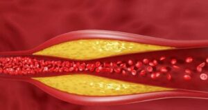 5 скриени причини за покачен холестерол! Не е сè до храната, ова може да биде и поттик!