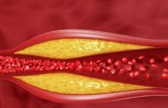 5 скриени причини за покачен холестерол! Не е сè до храната, ова може да биде и поттик!